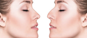 Visage-Rhinoplastie Dr Thierry Aboudaram