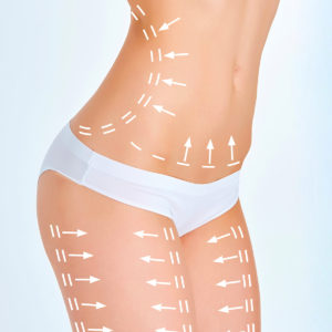 Silhouette-BodyLift Dr Thierry Aboudaram